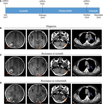 Osimertinib Resistance With a Novel EGFR L858R/A859S/Y891D Triple Mutation in a Patient With Non-Small Cell Lung Cancer: A Case Report